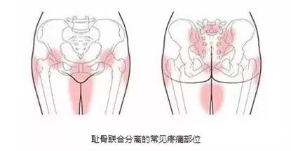 孕期耻骨分离产后怎么恢复,产后耻骨联合分离恢复最佳时间表