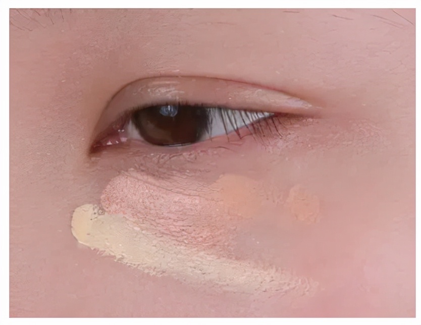 严重泪沟黑眼圈,淡化黑眼圈和泪沟原理