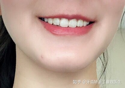 隐适美牙套矫正手法,隐适美牙套矫正的全过程