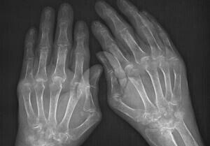 类风湿患者最好的治疗方法,类风湿痊愈患者经验