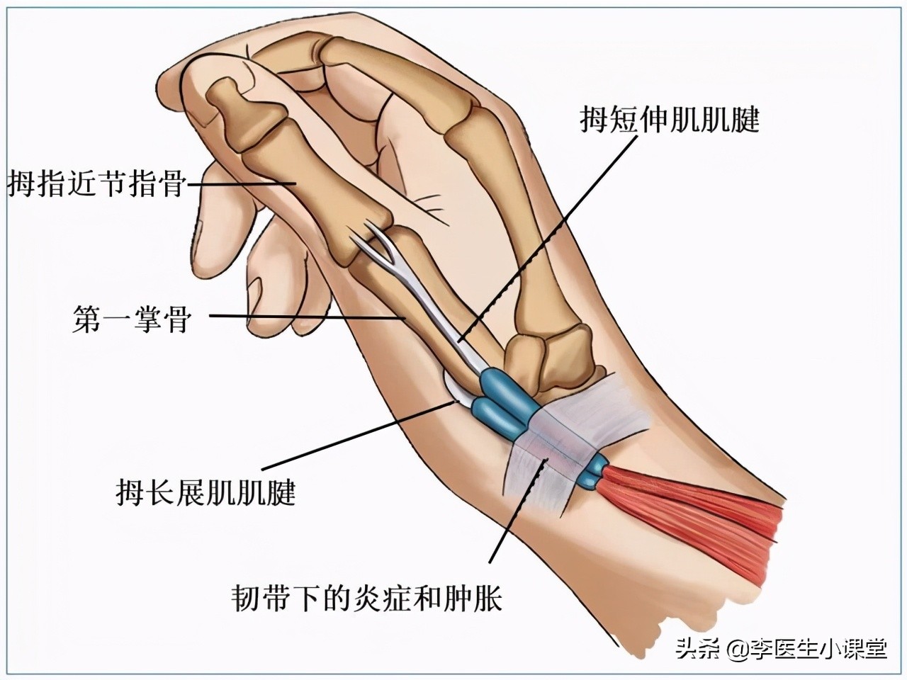 更年期易得腱鞘炎怎么办,更年期腱鞘炎最佳治疗方法