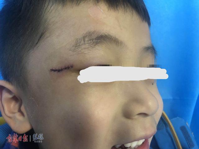 6岁男童在幼儿园磕伤眼角，最新进展：家长与园方达成一致