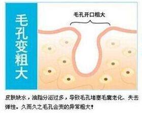 毛孔粗大肤质差如何去收缩毛孔,遮毛孔粗大收缩毛孔最有效的方法