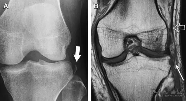 所有骨折都叫什么名字,骨折的名称有哪些