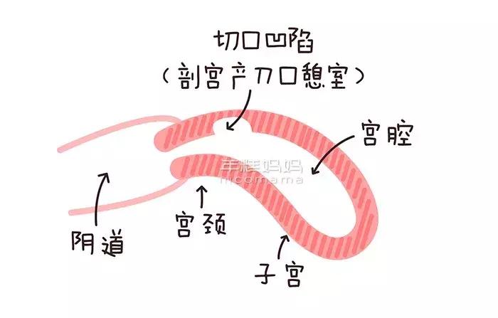 产后检查是第42天当天去吗,产后42天检查子宫还是大怎么办