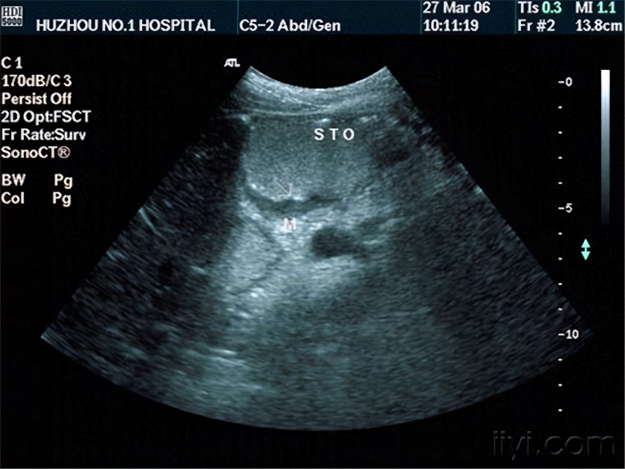 肝癌是如何确诊的？彩超能查出肝癌吗？听听专家怎么说