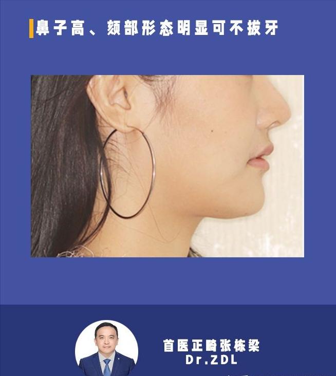 戴牙套矫正牙齿脸型会变好看吗,隐形牙套矫正后脸型变化