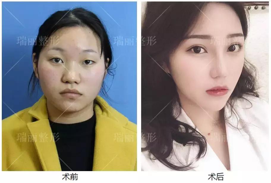 1元脱毛靠谱吗,0元免费脱毛