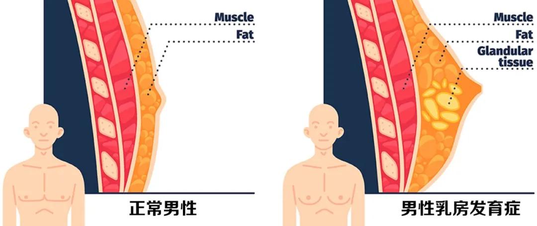 男性乳房发育在家如何治疗,男性乳房发育导致腋下不舒服