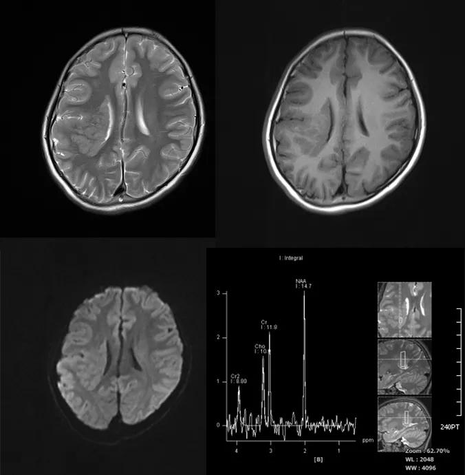 先天性颅脑发育不全,先天颅脑发育不良能治吗