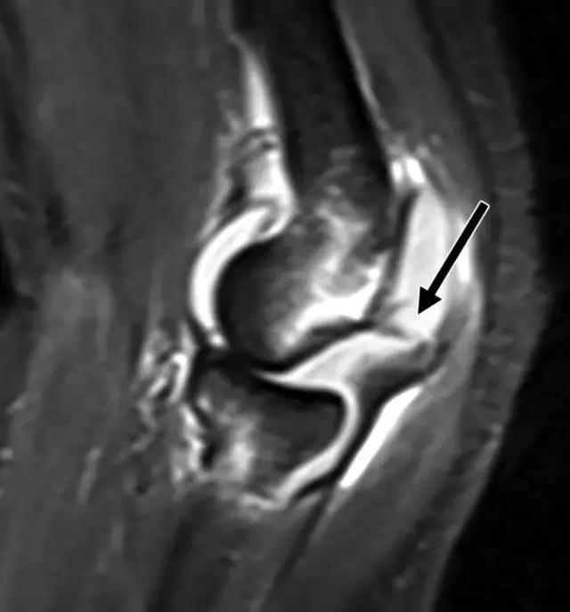 骨折处出现麻痹感,骨折跟精神状态有关