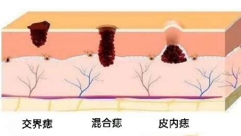 脸上太多痣了怎么能让它自动消失,脸上痣太多怎么在家去除