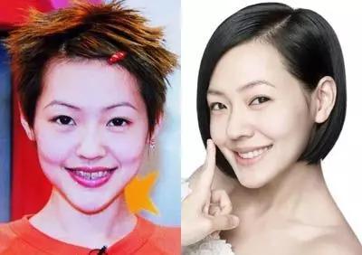 吴宣仪烤瓷牙怎么做,吴宣仪的整牙前