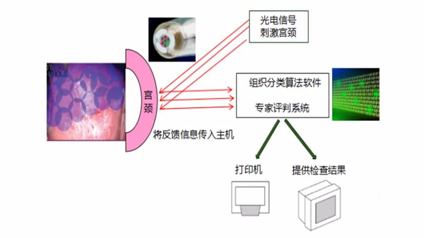 宫颈癌筛查有关新闻报道,好消息宫颈癌