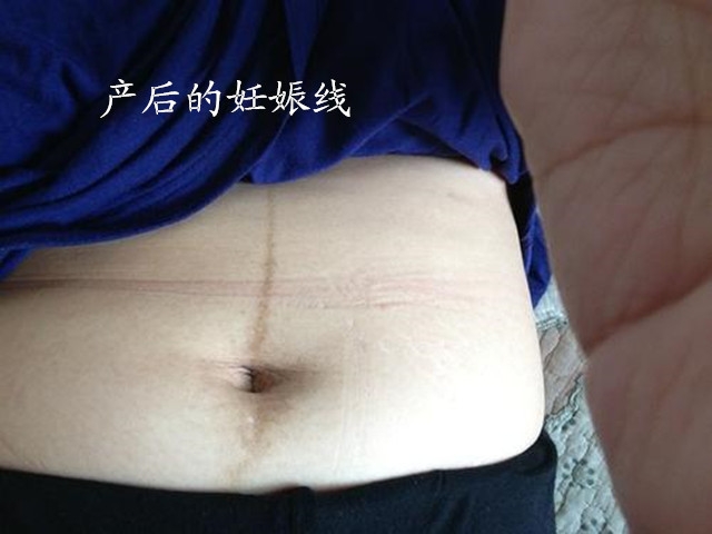孕多久长肚皮上的黑线,怀孕了肚皮上长黑毛
