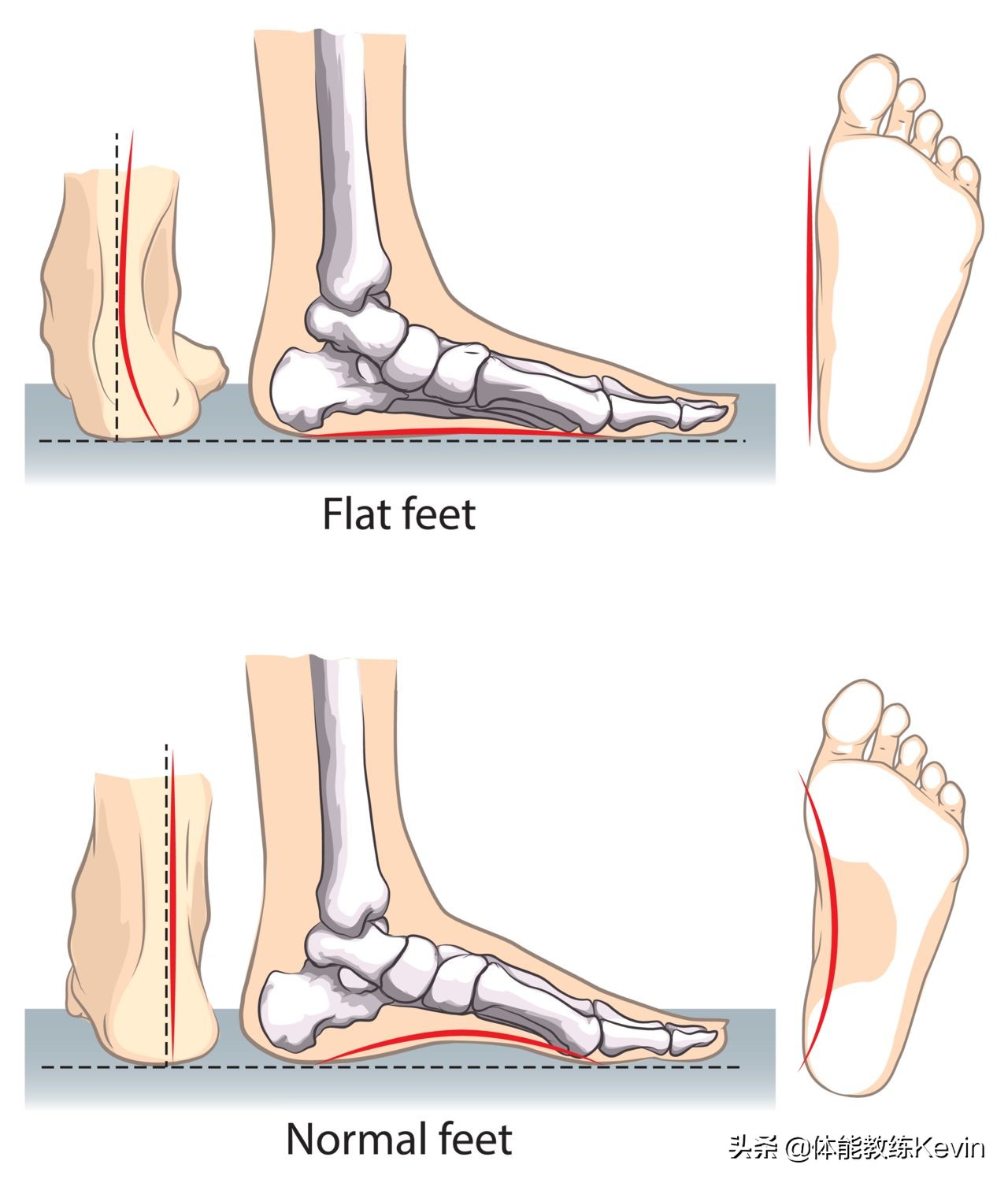 小儿足外翻康复训练弹力绷带,儿童足外翻康复训练教程