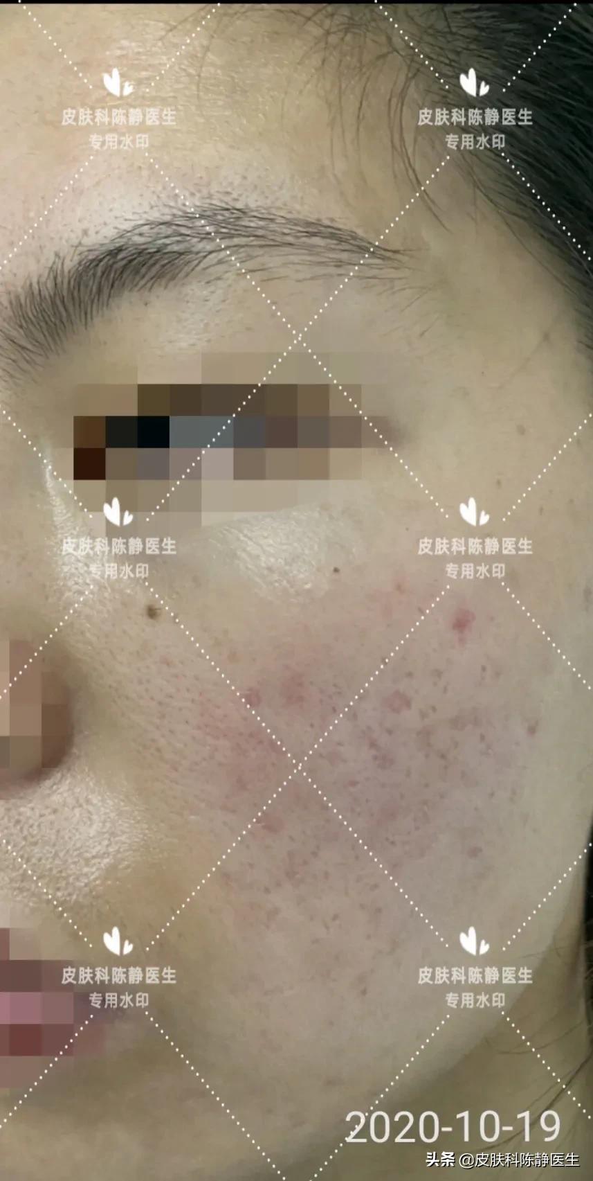 暗疮和青春痘有什么区别,痤疮青春痘常见十八问