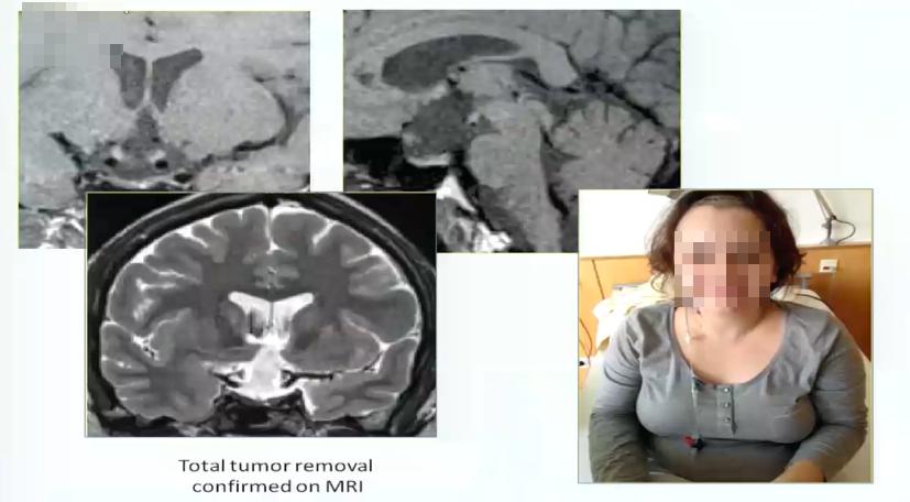 INC巴特朗菲教授视频|视神经-下丘脑胶质瘤全切案例集及治疗解读