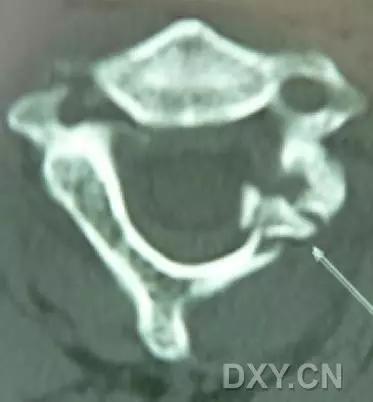 几种严重骨折医学名称,常见的骨折有哪些名称