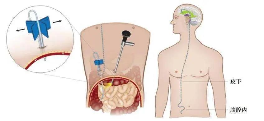 脑室积水有哪些症状,脑积水的水是什么样子