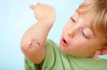 处理擦伤伤口的正确步骤是什么,擦伤伤口有渗出液怎么处理