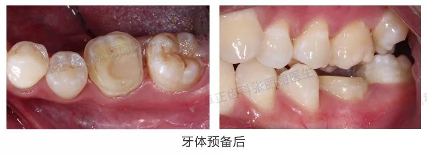 牙齿缺损全瓷冠修复多少钱,牙齿楔状缺损修复大概多少钱