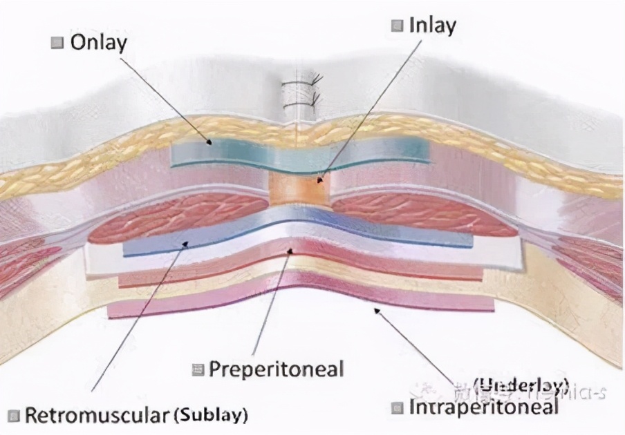 怎么治疗脐疝,如何治疗脐疝