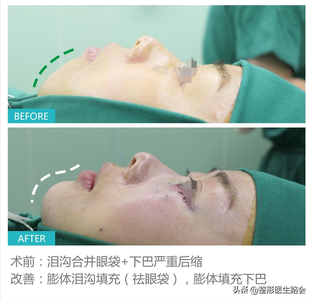 做假体下巴的真实案例,做假体下巴后的真实感受