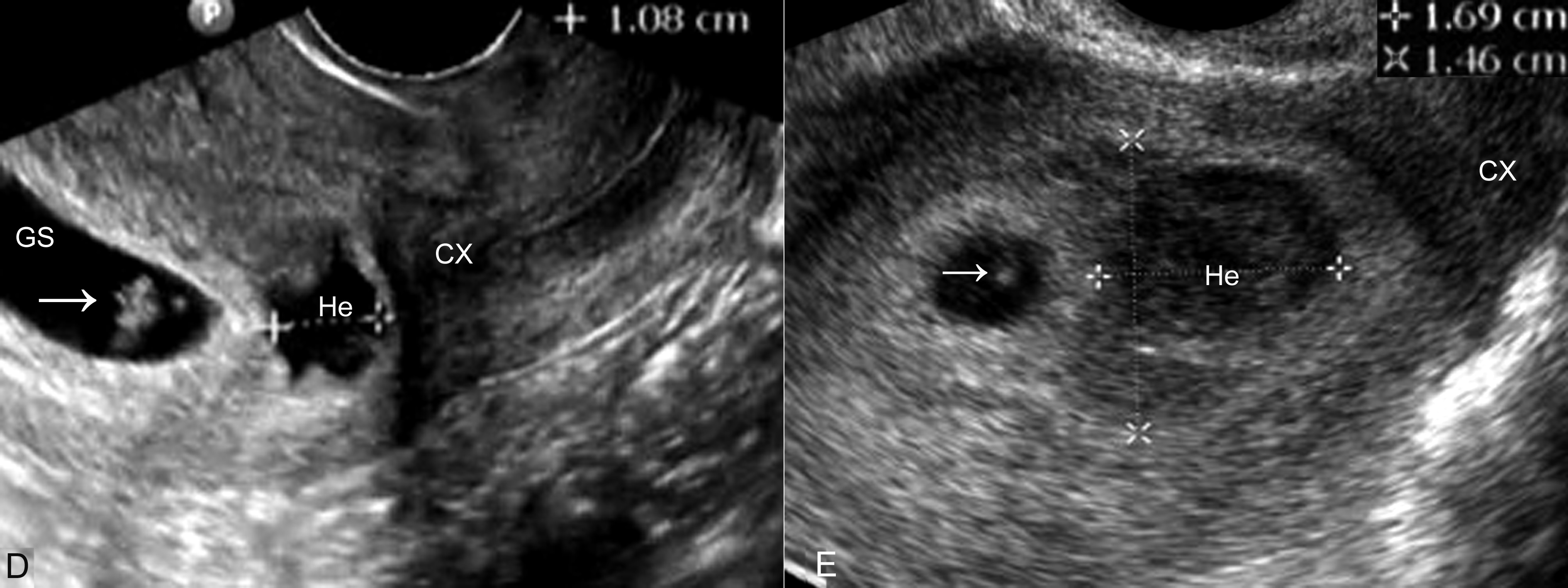 明明白白做超声32-3:流产:超声检查