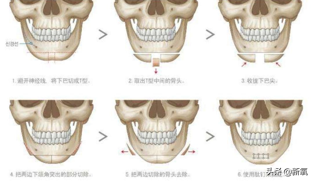 18岁土肥圆豪掷800万全身整形，鼻子6次大整假体穿出，效果却超美