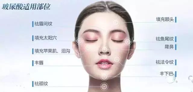 明星注射玻尿酸案例,注射玻尿酸变美