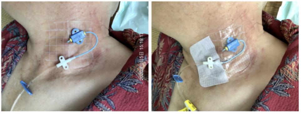 又见接触性皮炎？！不妨试试地塞米松+水胶体