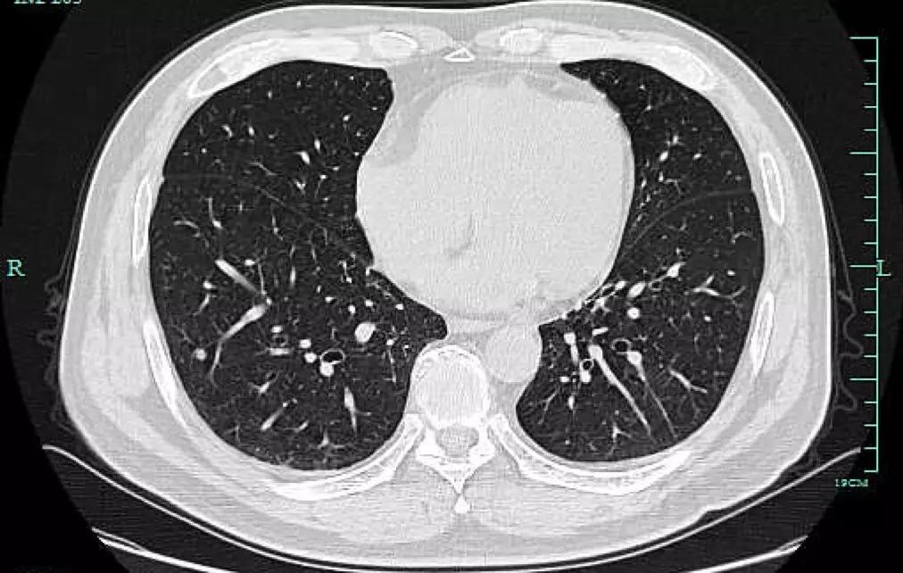 查出肺结节记住四个不要,1.38磨玻璃肺结节到底切不切