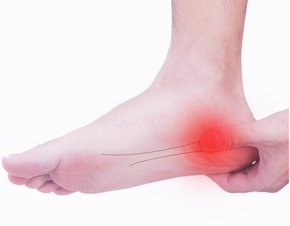 足跟痛该如何治疗,倪海厦治疗足跟痛