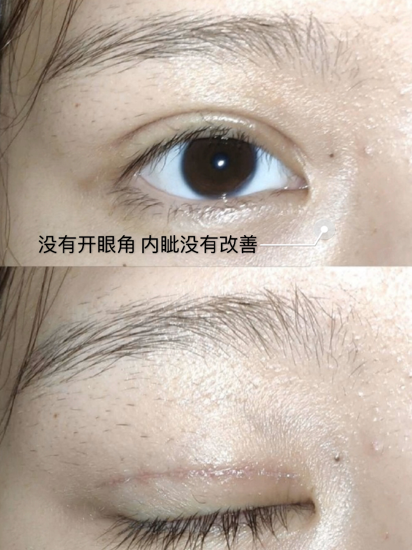 眼角开的形状不自然能修复么,眼角开大了恢复后会变小吗