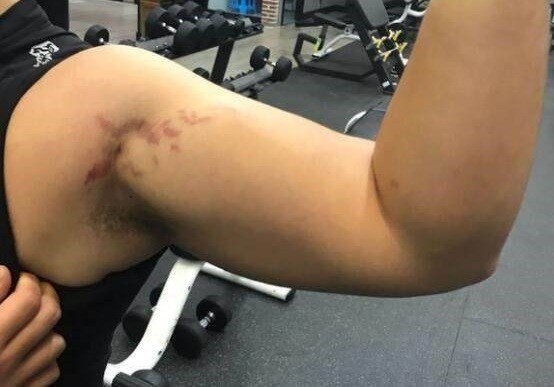 健身后肌肉上有红色纹路,健身后有条纹怎么回事