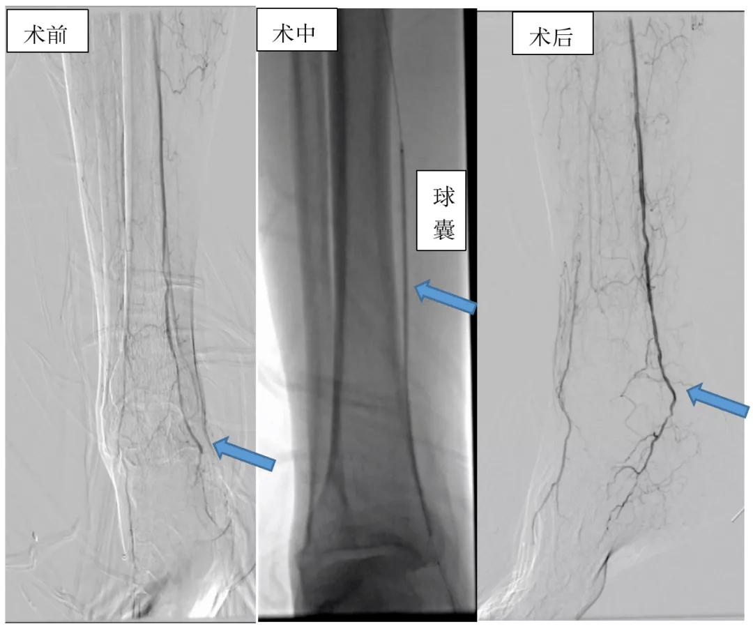 老烂腿清创手术要多少钱,老烂腿清创换药步骤