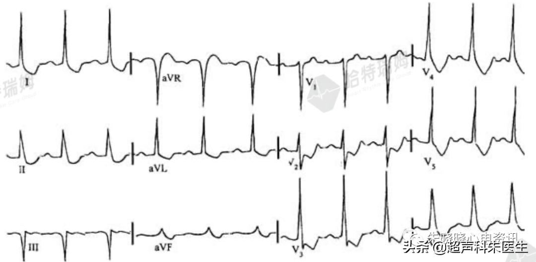 t波倒置9个真相图解,t波倒置判断口诀