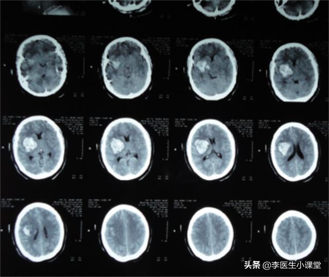 血压高突发脑出血怎么治疗30岁,高血压脑出血突然发作该如何急救
