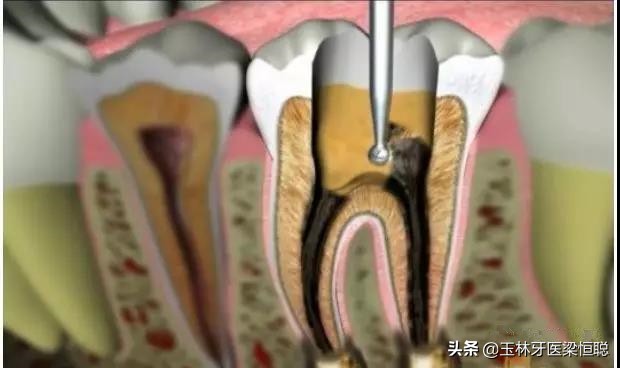 牙坏了医生说保不住为什么不给拔,牙崩了一半怎么补牙