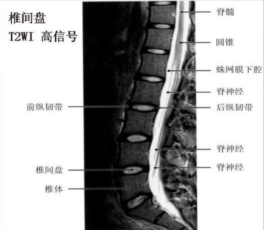 腰疼椎管狭窄压迫神经怎么治疗,腰疼椎管狭窄有什么办法
