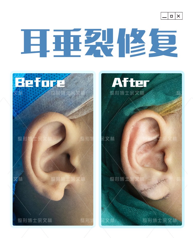 耳垂畸形多大可以手术,耳垂畸形是什么原因导致的