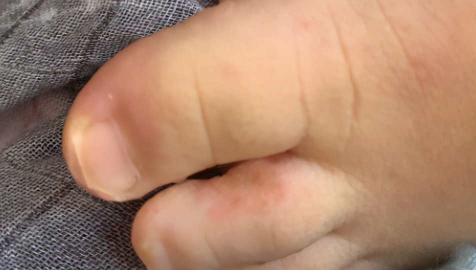 宝宝指甲有白斑倒刺缺什么元素,孩子指甲出白点是缺钙吗