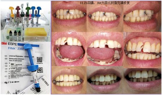 600补一颗牙齿贵吗,诊所补一颗牙多少钱