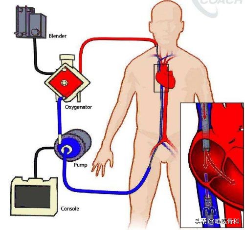 新型肺炎治愈会留后遗症吗,肺炎是否会扩散到骨