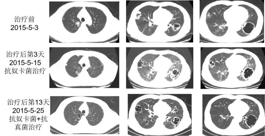 PCCM直播丨中年装修工人双肺多发空洞，奴卡菌＋曲霉菌如何治疗？