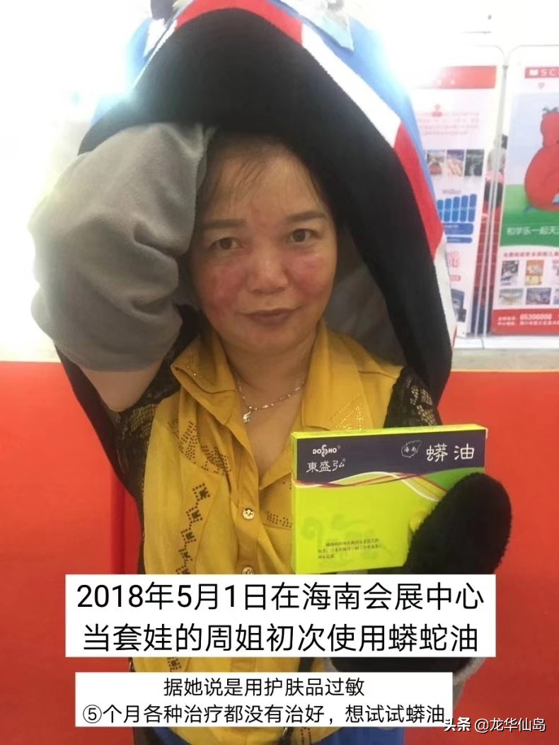 蟒蛇油使用案例与方法