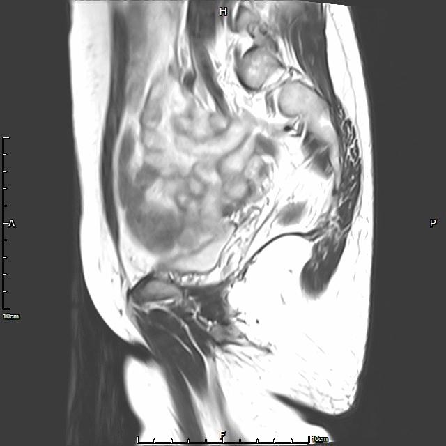 子宫腺肌症介入栓塞全国哪里好,子宫腺肌症介入栓塞治疗报销吗