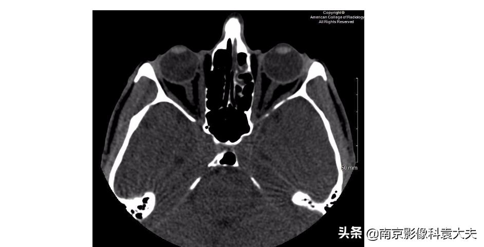 22岁男子眼睛意外失明,中年男子突然右眼失明半小时