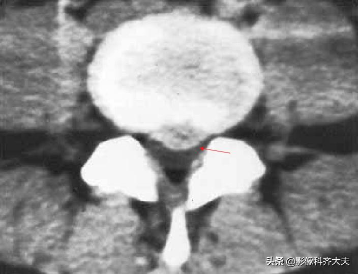 腰椎间盘突出最好的影像诊断方法,腰椎间盘突出的影像学检查